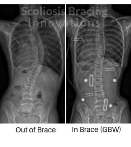 in-brace scoliosis correction