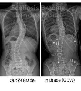 in-brace scoliosis correction