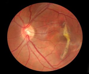 optomap-retina-scan