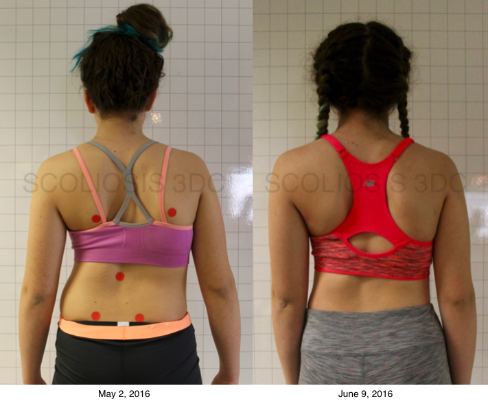 this girl was able to avoid scoliosis surgery and improve posture