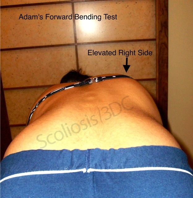 Adams bend test showing signs of scoliosis